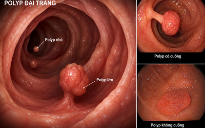 3 thực phẩm quen thuộc, dễ tìm có thể ngăn ngừa polyp đại tràng, nhiều gia đình Việt có sẵn trong bếp