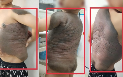 Bé trai Hà Nội mang khối u khổng lồ như "mai rùa" đến gặp bác sĩ: Sau 7 năm lần đầu tiên đứng thẳng như bao bạn bè trang lứa