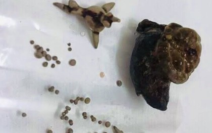Bệnh sỏi thận: Vì sao trong cùng 1 quả thận lại có các viên sỏi khác nhau và chia sẻ của bác sĩ "không còn phải bổ đôi quả thận tìm sỏi"