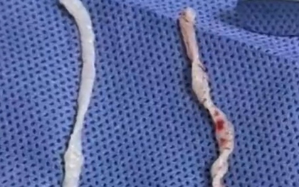 Đau cánh tay suốt một năm, người phụ nữ bàng hoàng khi bác sĩ phát hiện hai sinh vật dài 10cm đang sống dưới da