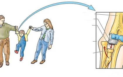 Bác sĩ cảnh báo: Kéo tay con kiểu này, chỉ cần 1 cái cũng có thể khiến trẻ bị trật khớp khuỷu tay