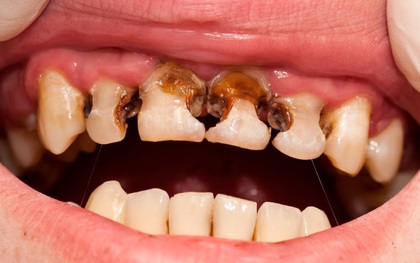 Trẻ thiếu canxi thường phát ra 5 tín hiệu: Bệnh viện Nhi đồng 2 cảnh báo đừng chủ quan