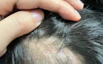 Bé gái 5 tuổi rụng tóc hói vĩnh viễn cả 1 mảng vì 1 hành động tưởng chừng vô hại