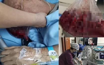 Người đàn ông nôn ra hơn 2 lít máu trong 5 phút, bác sĩ cảnh báo: 4 thói quen ăn uống "phá nát" dạ dày