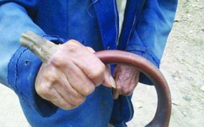 Kỳ lạ cụ ông 98 tuổi "mọc sừng" trên tay