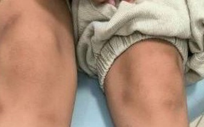 Ăn thịt nướng cuốn xà lách, bé trai 6 tuổi nổi đầy vết bầm tím "bất thường"