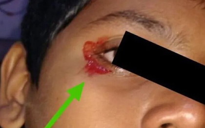 Bé trai 11 tuổi khóc ra máu khiến bác sĩ kinh ngạc