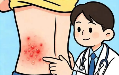 Đau đến mất ngủ nhiều đêm, bệnh zona thần kinh không còn là "bệnh người già": Cảnh báo 4 dấu hiệu miễn dịch suy yếu mà người trẻ bỏ qua