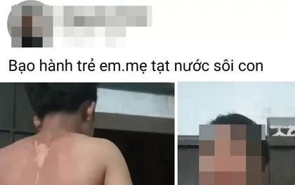 Công an vào cuộc vụ bé trai ở Đắk Lắk nghi bị mẹ tạt nước sôi