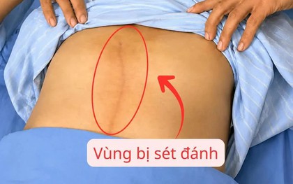 Thoát nguy kịch sau khi bị sét đánh lúc đang lao động