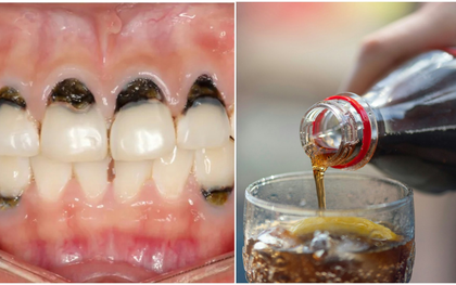 Người phụ nữ 30 tuổi cả hàm chân răng đen sì, mùi hôi nồng nặc vì 1 loại nước vạn người mê