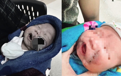 Nửa khuôn mặt bị u máu chiếm chỗ... và một cuộc chạy đua với từng giọt máu cứu sống em bé mới 1 tháng tuổi