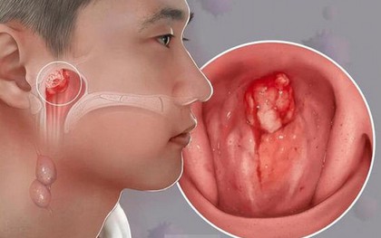 Con bị ù tai thôi mà... và cú sốc của gia đình khi bé trai 14 tuổi được chẩn đoán ung thư giai đoạn tiến triển