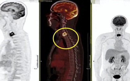 Người đàn ông sốt nhẹ 2 tháng, bác sĩ phát hiện đốt sống cổ bị "đục thủng": Thủ phạm giấu trong căn bếp nhiều gia đình