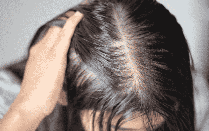 Tưởng stress vì thi cử nên rụng tóc, cô gái 22 tuổi phát hiện căn bệnh đang âm thầm đang phá hủy thận