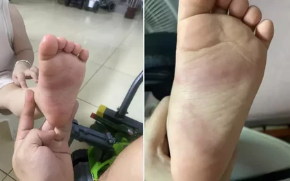 Xác minh thông tin bé trai 3 tuổi nghi bị giáo viên bạo hành ở Hưng Yên