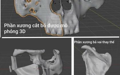 Chỉ trong 3 tháng, người đàn ông Hà Nội bị “ăn mòn” một phần mặt: Nguyên nhân do đâu?