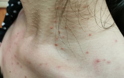 Cảnh báo: Các bệnh ung thư rất dễ "ngụy trang" dưới hình dạng của 4 loại mụn này