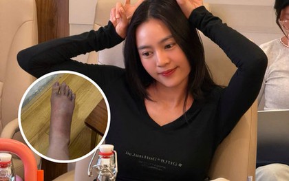 Ninh Dương Lan Ngọc mắc cúm B, chân sưng to gây lo lắng