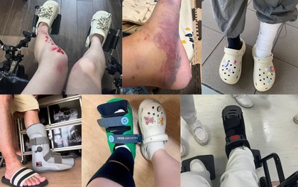 Lời khuyên cho những người thích đi dép sục, dép "kiểu crocs"