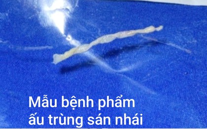Phát hiện sán dài 7cm trong cơ thể người đàn ông 40 tuổi ở Hà Nội, không ăn đồ tái sống