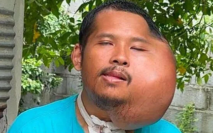 Xỉa răng sai cách, người đàn ông 31 tuổi có khuôn mặt "đáng sợ"