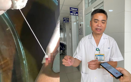Phát hiện ca giun rồng thứ 44 tại Việt Nam: Người đàn ông ở Lào Cai có vết "mụn" ở cánh tay, nặn ra 2 đoạn giun dài tới 20cm