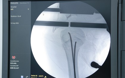 Bé gái 14 tuổi gãy xương cánh tay sau tai nạn xe đạp điện được phẫu thuật qua hai vết mổ nhỏ
