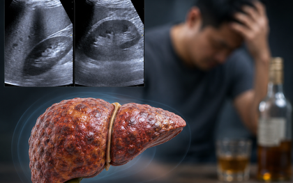 Viêm gan cấp, men gan tăng 18 lần sau 3 ngày liên tiếp dùng 1 loại đồ uống