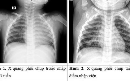 Phát hiện dị vật "bị bỏ quên" hơn 1 tháng trong phế quản bé trai 3 tuổi