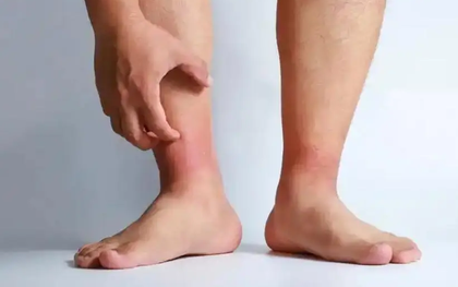 Chân sưng một bên, tuyệt đối đừng chủ quan: Cảnh báo dấu hiệu cục máu đông đang hình thành