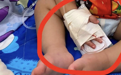 Bé 1 tuổi phải phẫu thuật nối ngón tay nghi do nhân viên y tế cắt trúng trong lúc tháo kim truyền