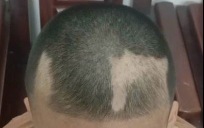 Đã cắt tóc '3 phân' nhưng nam sinh lớp 6 vẫn nhổ trụi từng mảng vì áp lực ôn thi