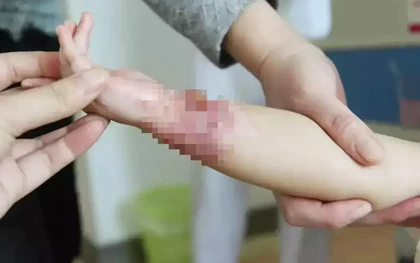 Bé trai 4 tuổi bị bỏng nước sôi 100°C, cách sơ cứu của người mẹ được bác sĩ khen ngợi