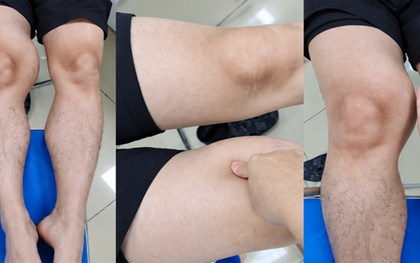 Đùi phình to như quả bóng suốt 1 năm, đi khám phát hiện ung thư hiếm gặp