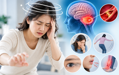 Chóng mặt, buồn nôn, mất thăng bằng: Khi nào là dấu hiệu đột qụy?