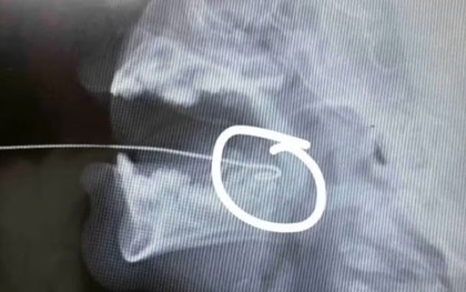 Bất cẩn khi đùa giỡn, bé 13 tháng tuổi bị ăng ten đồ chơi xuyên qua lưỡi