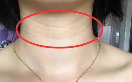 Một khi 3 hiện tượng này xuất hiện trên cổ bạn: Đừng bất cẩn, nên đi khám ngay