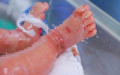 Bé trai sinh non mắc bệnh vảy cá hiếm gặp