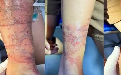 Cảnh giác sứa đốt khi tắm biển