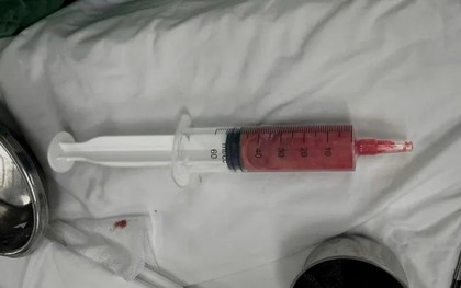 Bệnh viện Trung ương Quân đội 108 cảnh báo những người tiêm filler 5-10 năm trước