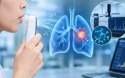 Nghiên cứu công nghệ nhận diện nốt phổi có nguy cơ ung thư từ hơi thở