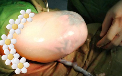 Bé gái song sinh IVF "đẻ bọc điều" đúng ngày Quốc khánh 2/9 sau 3 năm mẹ mong con