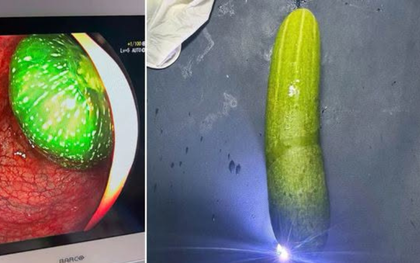 Nam sinh lớp 9 nhập viện vì trót đưa quả dưa chuột 20cm vào hậu môn