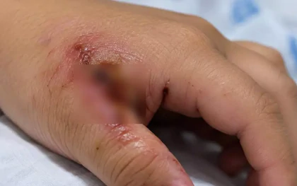 Uốn ván nặng, bé trai 7 tuổi co giật liên tục