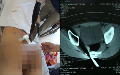 Hà Nội: Hãi hùng nam thanh niên nhập viện với con dao đâm xuyên qua mông