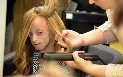 Bé gái bị lão hóa nhanh gấp 8 lần người thường đã có bộ tóc mới