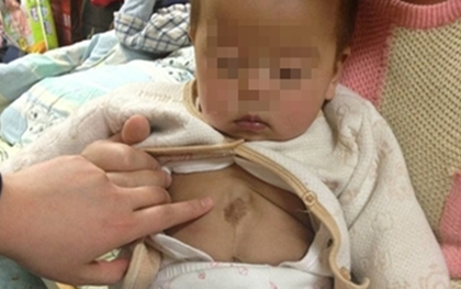 Bé trai 6 tháng tuổi có tim “chạy” khỏi lồng ngực
