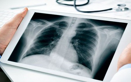 4 ''thủ phạm'' gây ra ung thư phổi: Số 1 nhiều người Việt vẫn đang duy trì