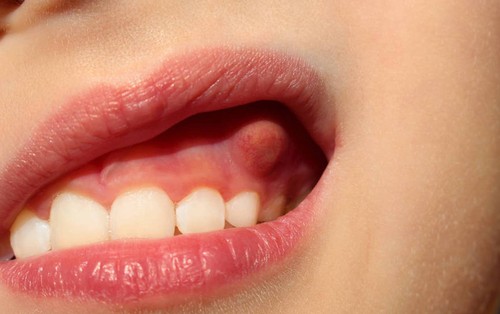 4 bất thường xuất hiện trong khoang miệng đang cảnh báo bệnh viêm nha chu, răng rụng ra mới phát hiện thì đã quá muộn